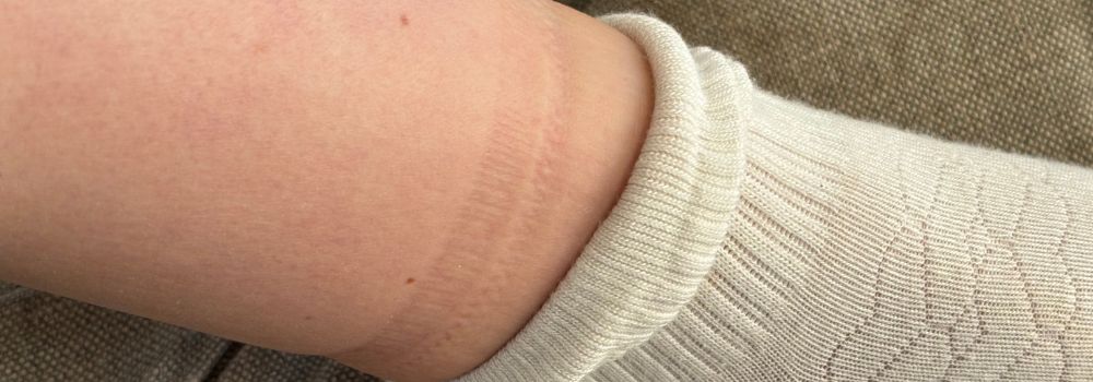 Sock Marks: What They Really Mean & When to Be Concerned